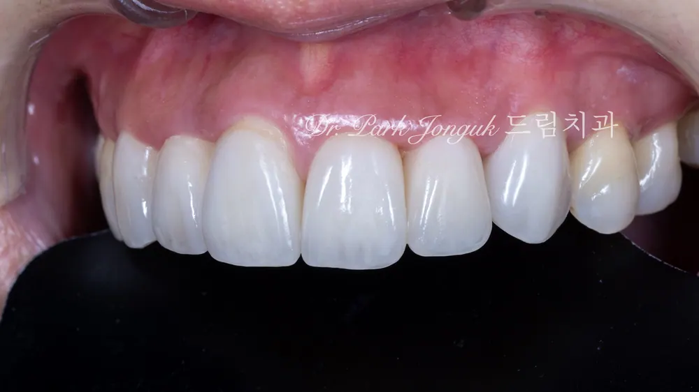 Retreating Problematic Veneers and All-Ceramic Crowns — photo 10