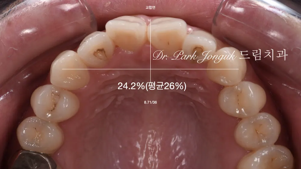 江南瓷贴面：任谁看都自然协调 — 图4