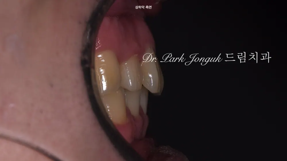 벌어진 치아와 왜소치에대한 앞니 라미네이트 치료 본문 사진 3