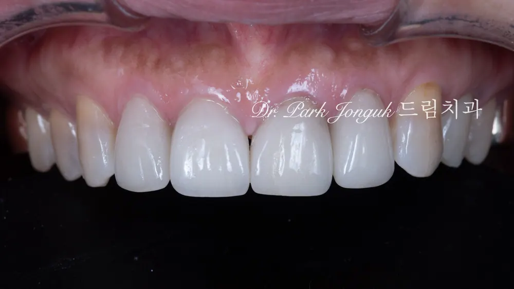 Worried About Darkened Veneers? Retreat Them with Hand-Layered Veneers — photo 1