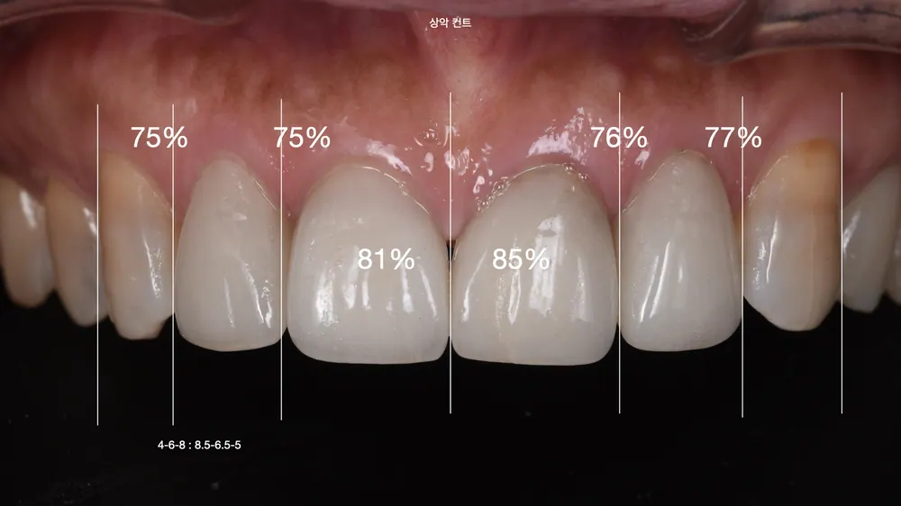 Worried About Darkened Veneers? Retreat Them with Hand-Layered Veneers — photo 2