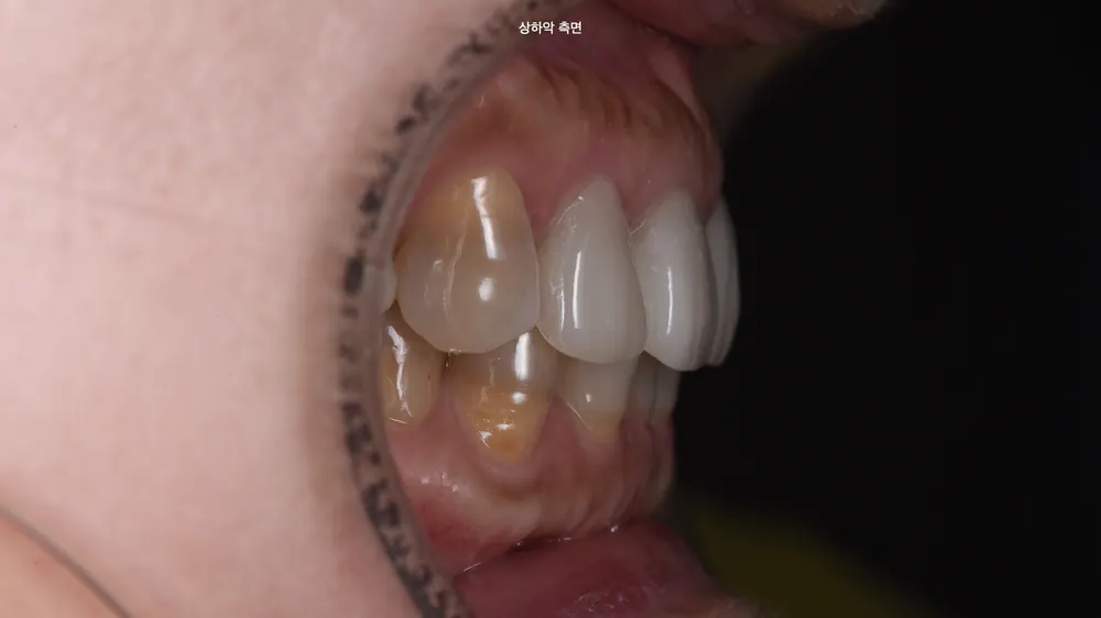 Worried About Darkened Veneers? Retreat Them with Hand-Layered Veneers — photo 3