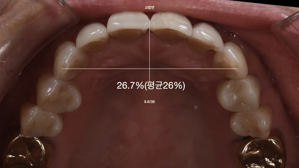 Worried About Darkened Veneers? Retreat Them with Hand-Layered Veneers — photo 4