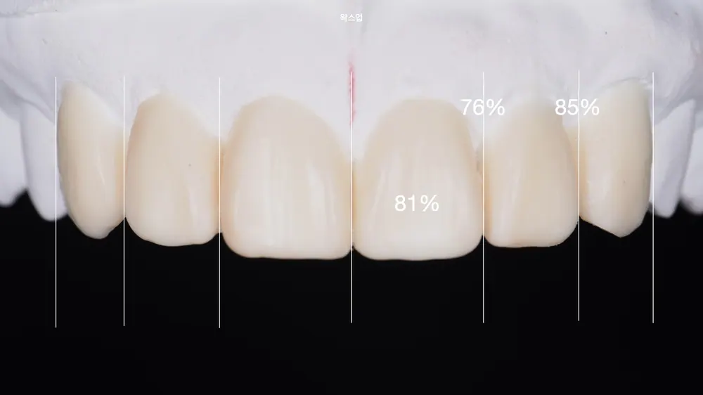 Worried About Darkened Veneers? Retreat Them with Hand-Layered Veneers — photo 5