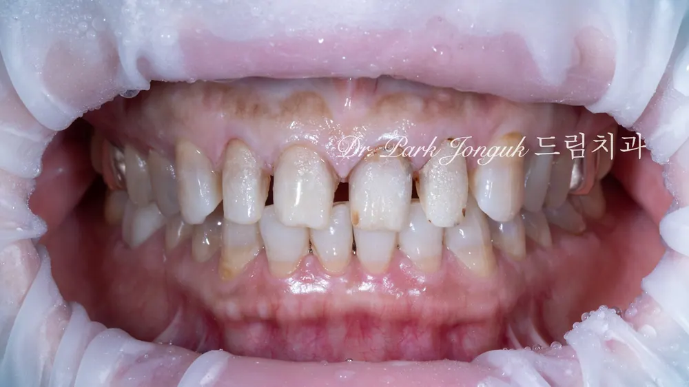 Worried About Darkened Veneers? Retreat Them with Hand-Layered Veneers — photo 6