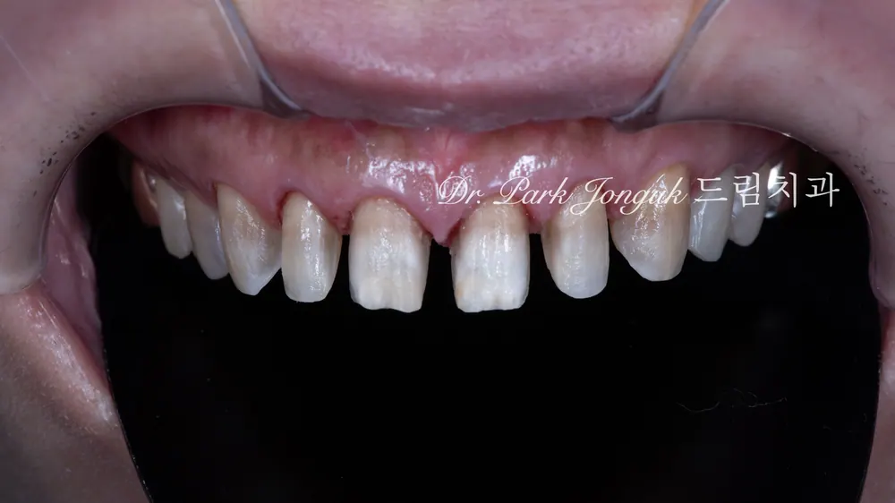 Worried About Darkened Veneers? Retreat Them with Hand-Layered Veneers — photo 7