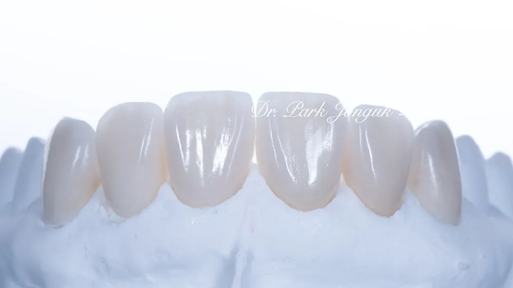 Worried About Darkened Veneers? Retreat Them with Hand-Layered Veneers — photo 8
