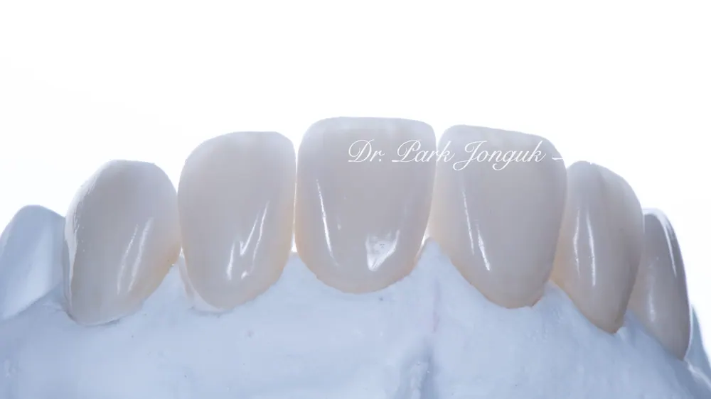 Worried About Darkened Veneers? Retreat Them with Hand-Layered Veneers — photo 9