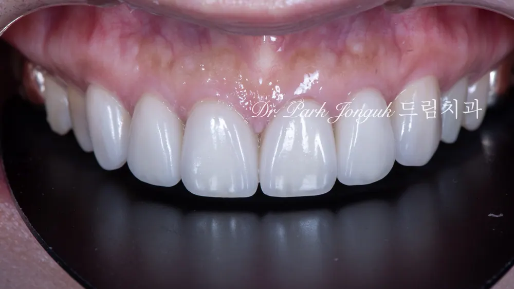 Worried About Darkened Veneers? Retreat Them with Hand-Layered Veneers — photo 10