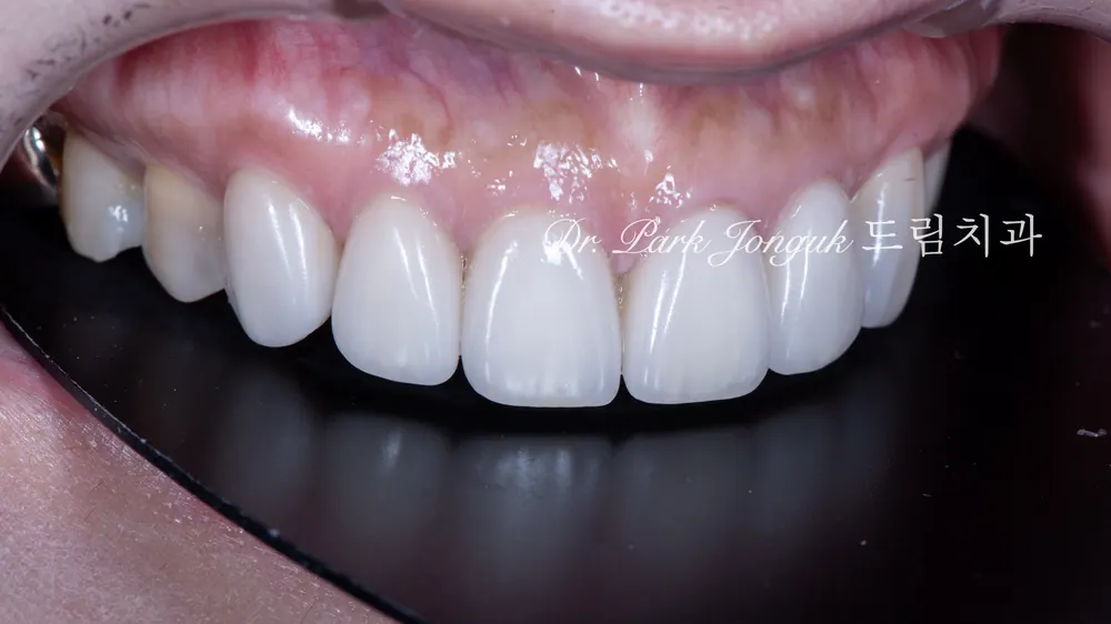 Worried About Darkened Veneers? Retreat Them with Hand-Layered Veneers — photo 11