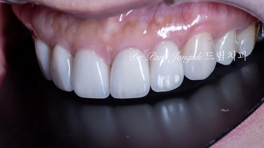 Worried About Darkened Veneers? Retreat Them with Hand-Layered Veneers — photo 12