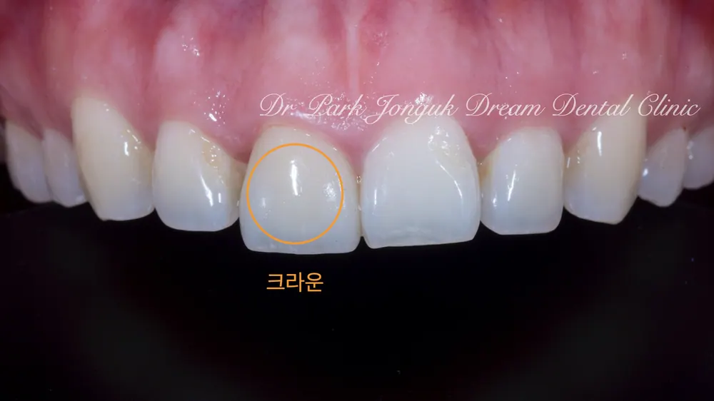 크라운과 라미네이트 차이 안나게 시술이 가능할까요? 본문 사진 2