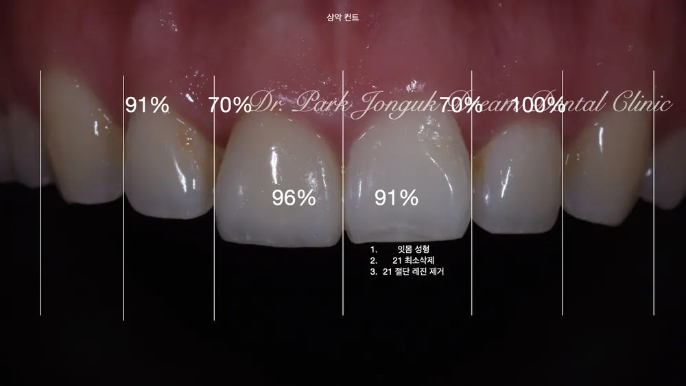 크라운과 라미네이트 차이 안나게 시술이 가능할까요? 본문 사진 3