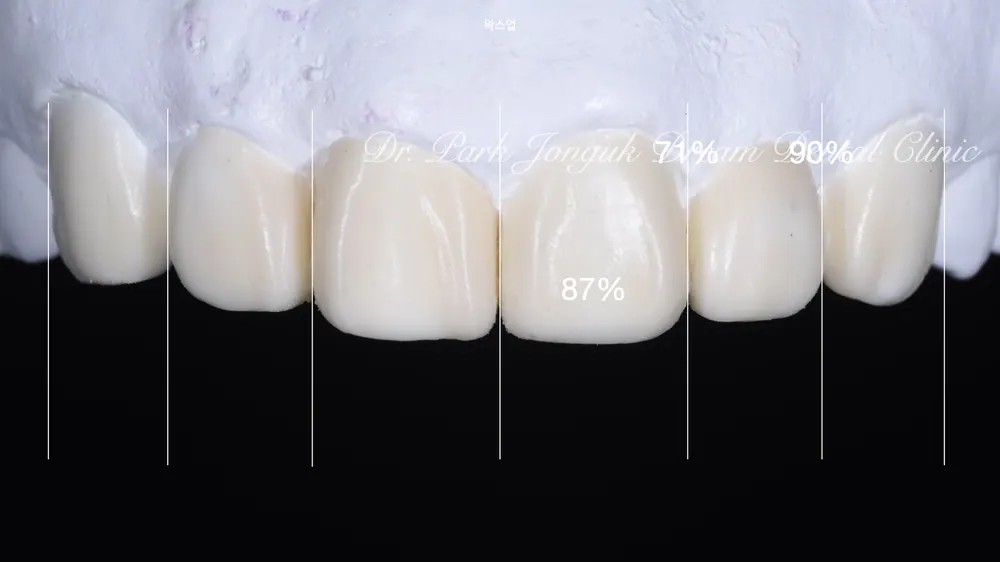 크라운과 라미네이트 차이 안나게 시술이 가능할까요? 본문 사진 5