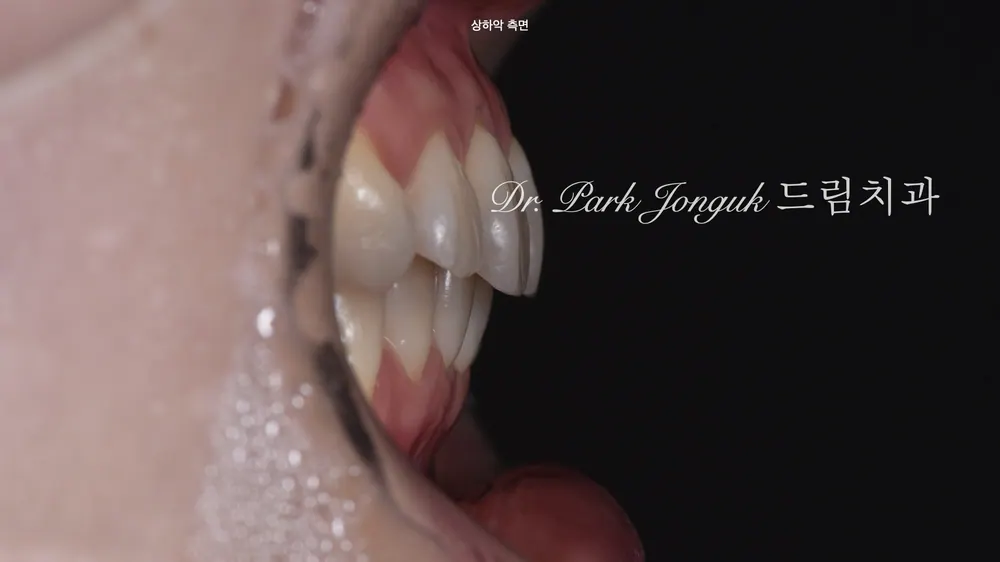 선천적 변색이 있는 치아는 라미네이트로 심미성 살리기 본문 사진 4