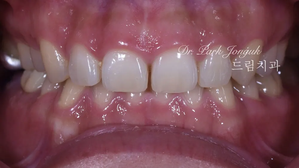 Treating a Retroclined Bite After Braces With No-Prep Veneers — photo 1