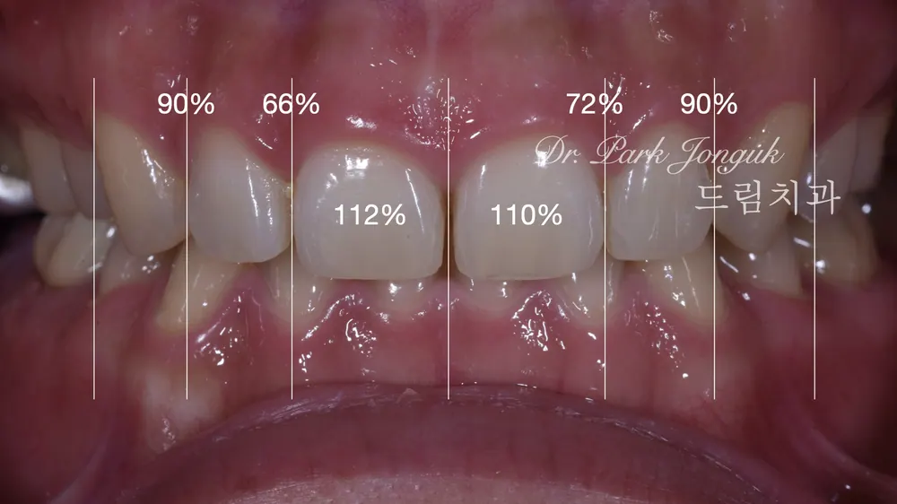 Treating a Retroclined Bite After Braces With No-Prep Veneers — photo 3
