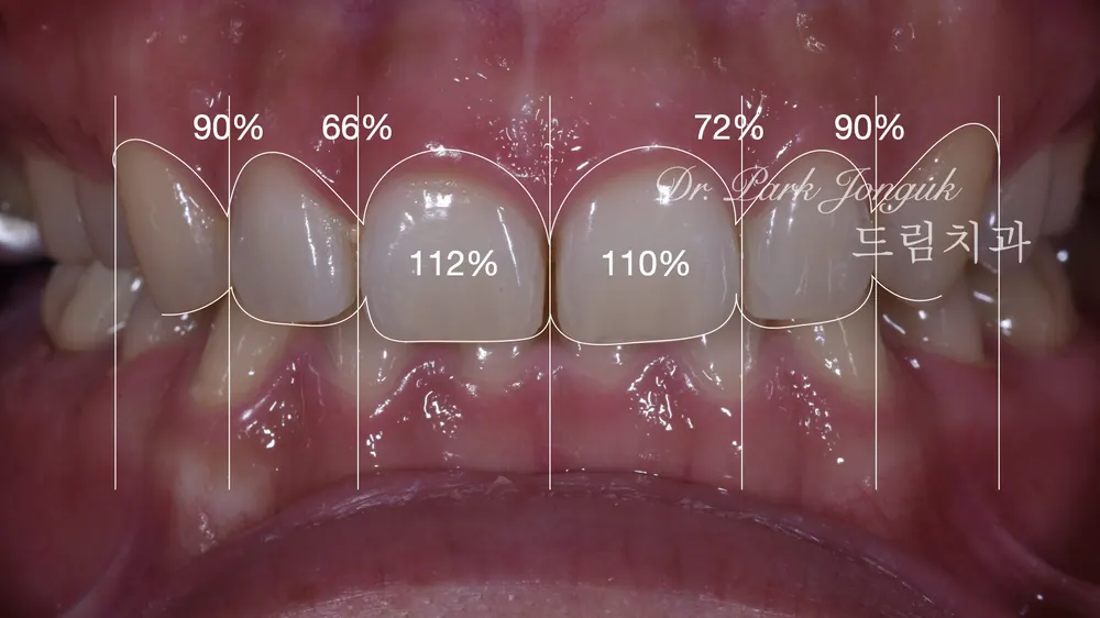 Treating a Retroclined Bite After Braces With No-Prep Veneers — photo 4