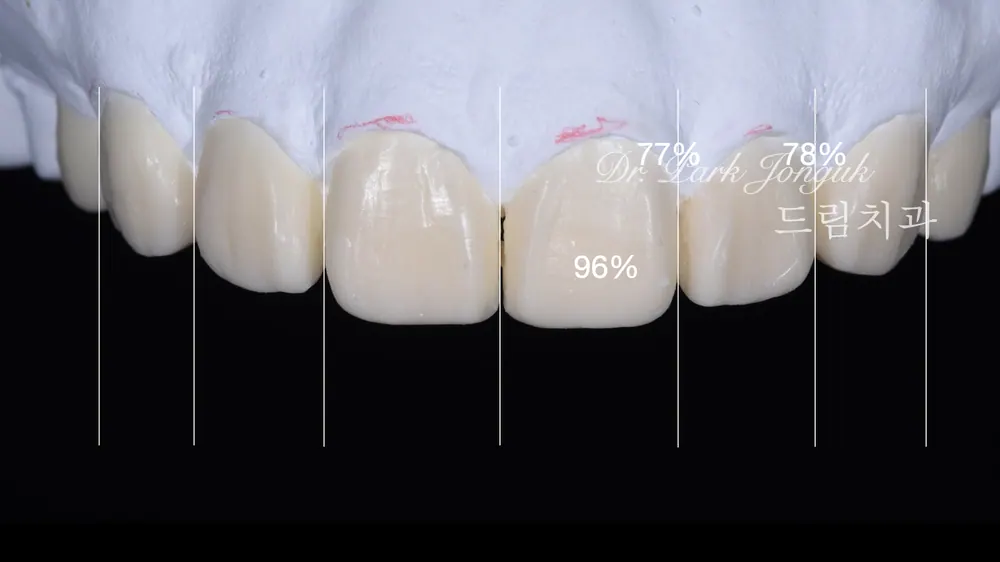 Treating a Retroclined Bite After Braces With No-Prep Veneers — photo 5