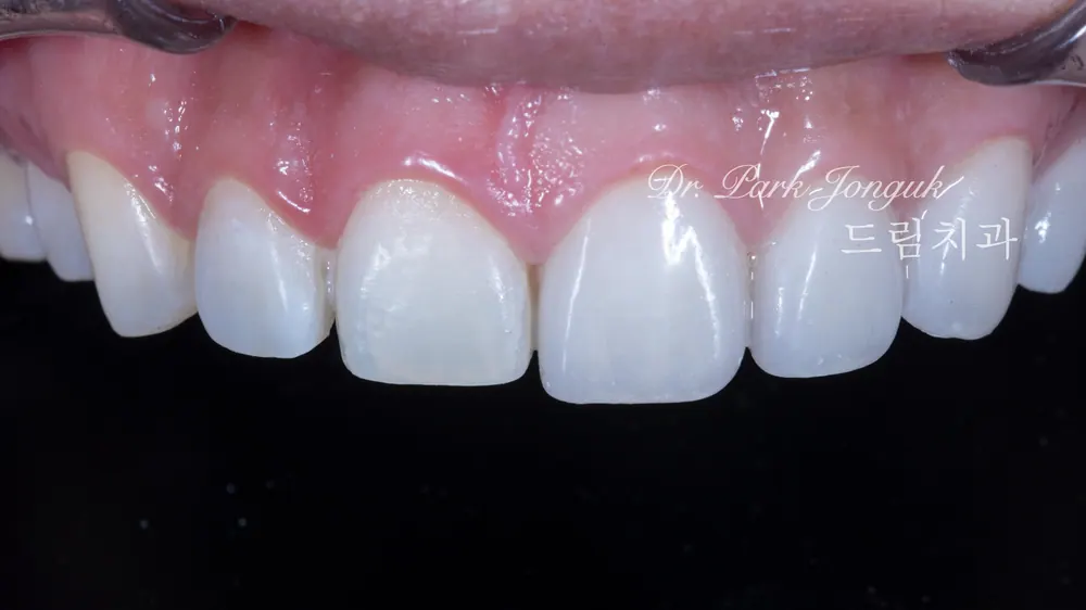Treating a Retroclined Bite After Braces With No-Prep Veneers — photo 8