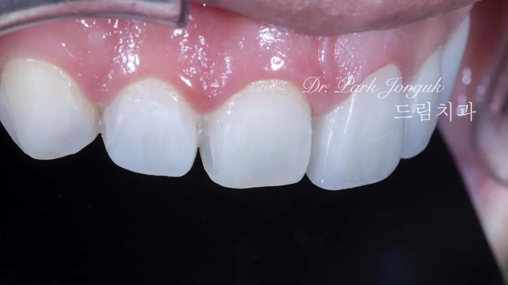 Treating a Retroclined Bite After Braces With No-Prep Veneers — photo 9