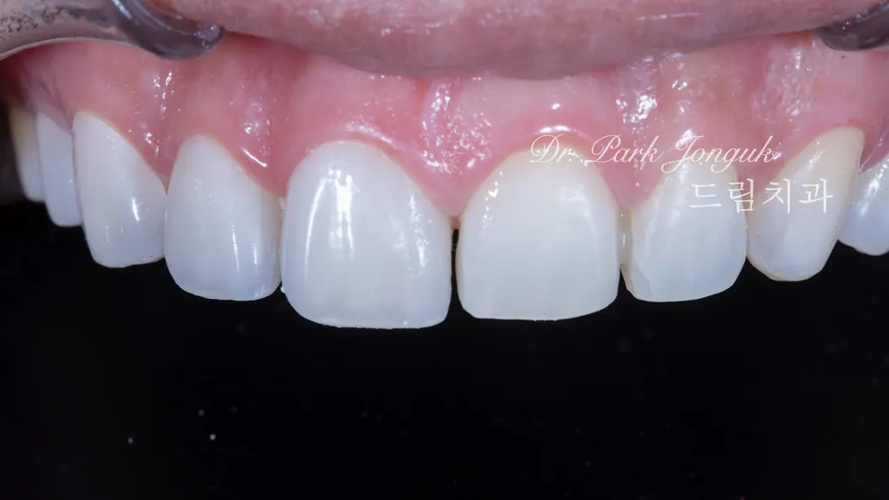 Treating a Retroclined Bite After Braces With No-Prep Veneers — photo 10