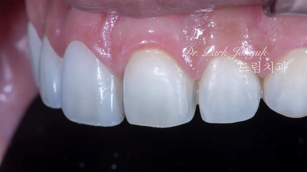 Treating a Retroclined Bite After Braces With No-Prep Veneers — photo 11
