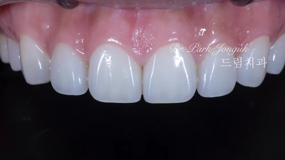 Treating a Retroclined Bite After Braces With No-Prep Veneers — photo 12