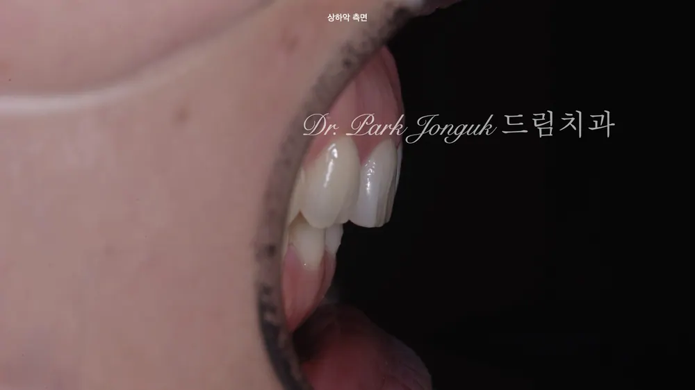 무삭제 라미네이트와 미세삭제 라미네이트의 차이! 본문 사진 3