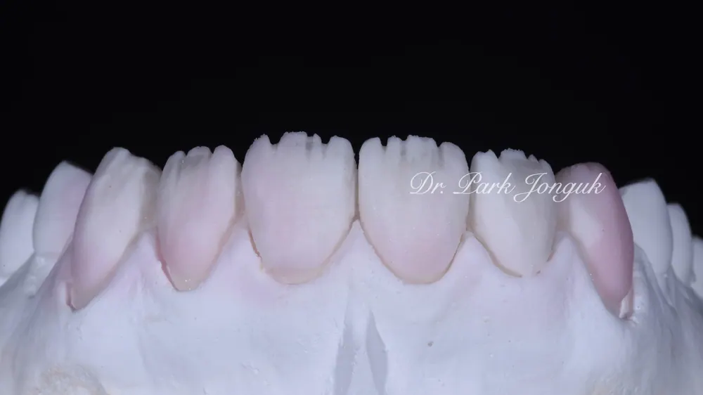 Four Ways to Fabricate Laminate Veneers, Part 2 — photo 7