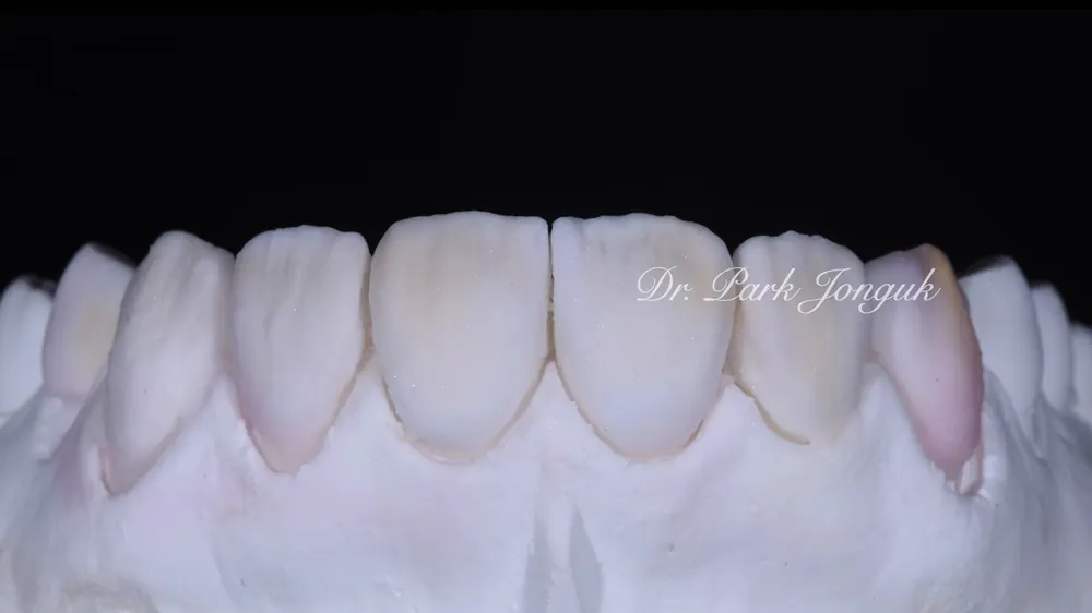 Four Ways to Fabricate Laminate Veneers, Part 2 — photo 8