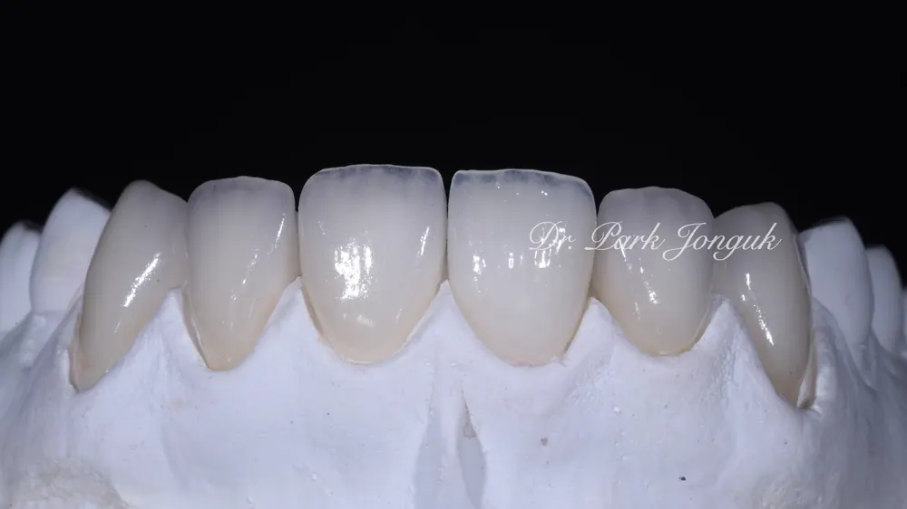Four Ways to Fabricate Laminate Veneers, Part 2 — photo 9