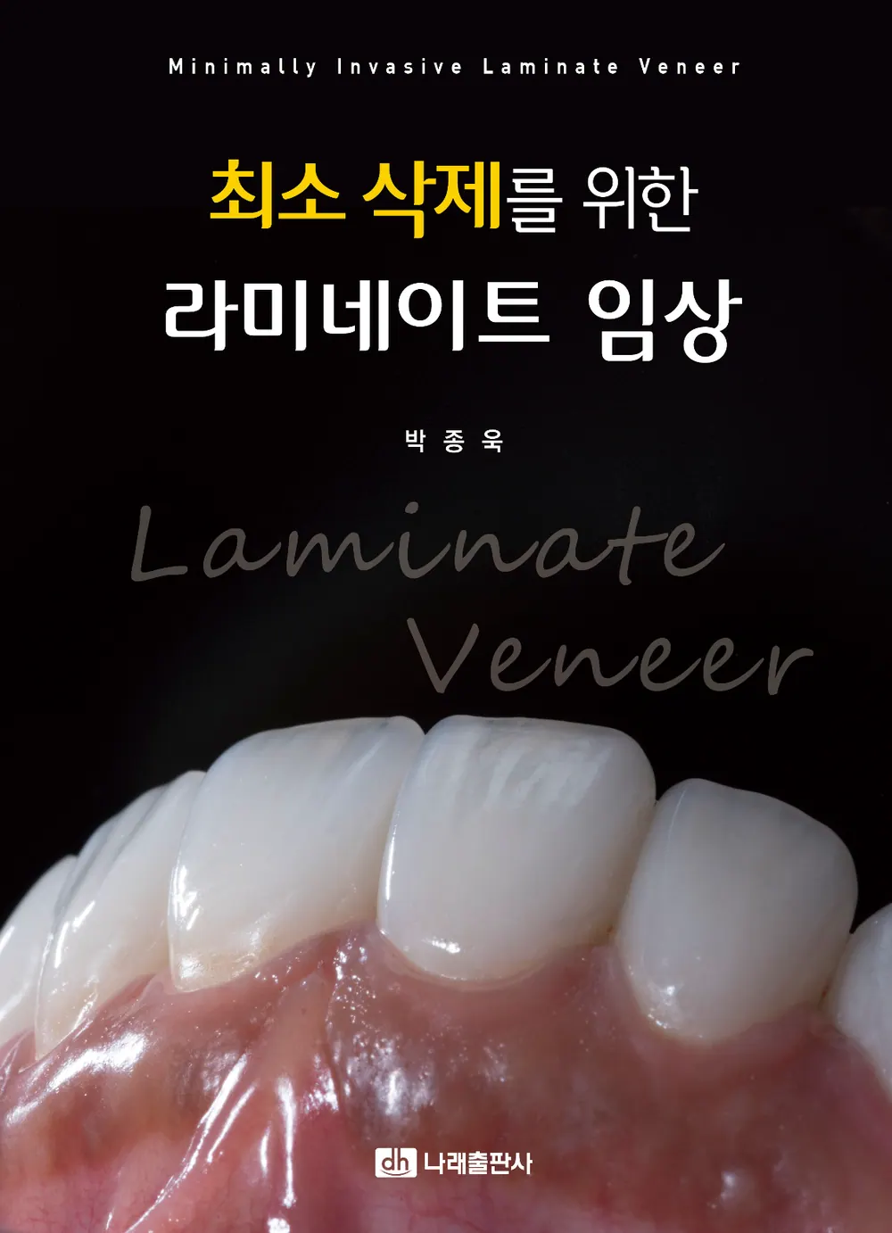 치아 교정 후 옥니가 된 상태에서 무삭제 라미네이트 본문 사진 7