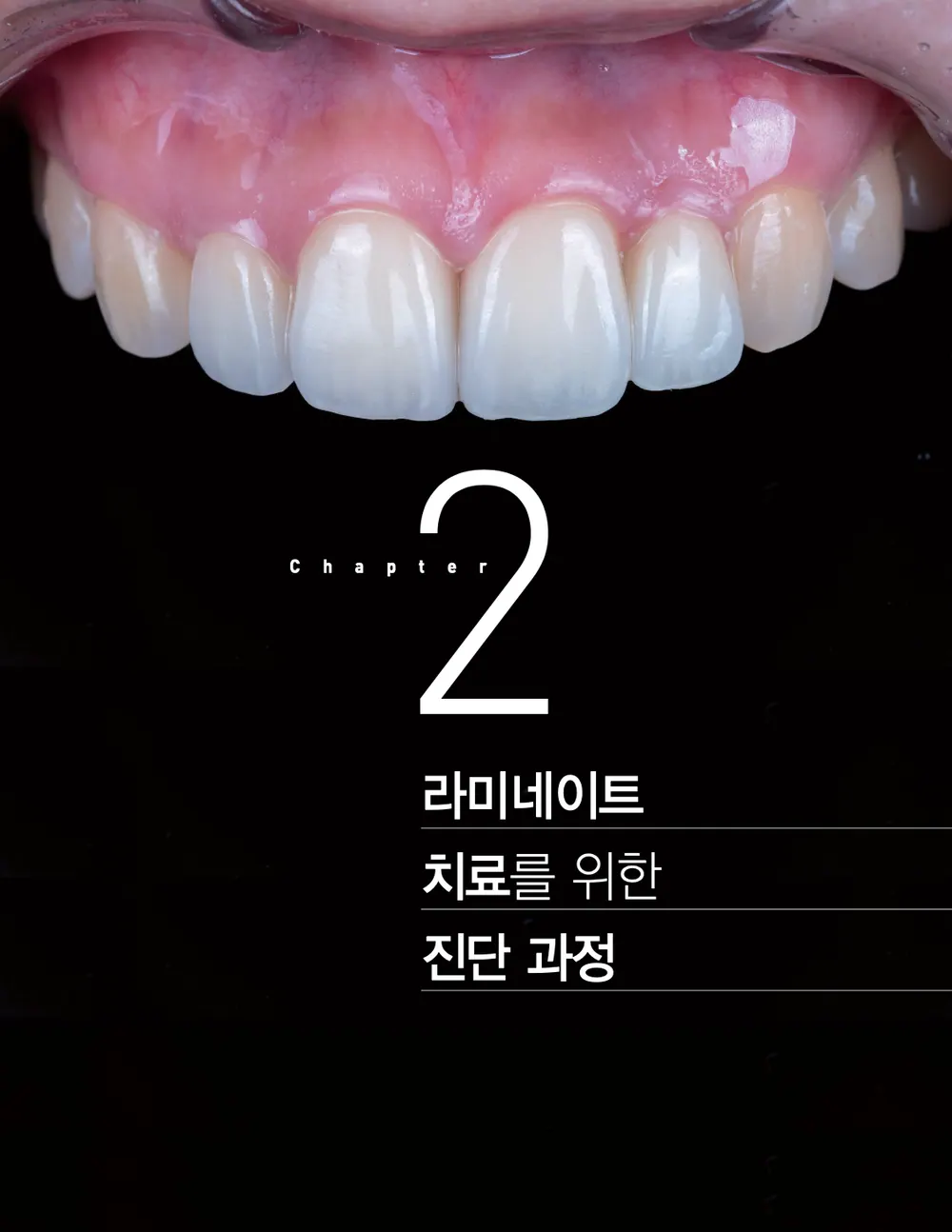 앞니 라미네이트 진단에서 치과의사의 역할! 본문 사진 2