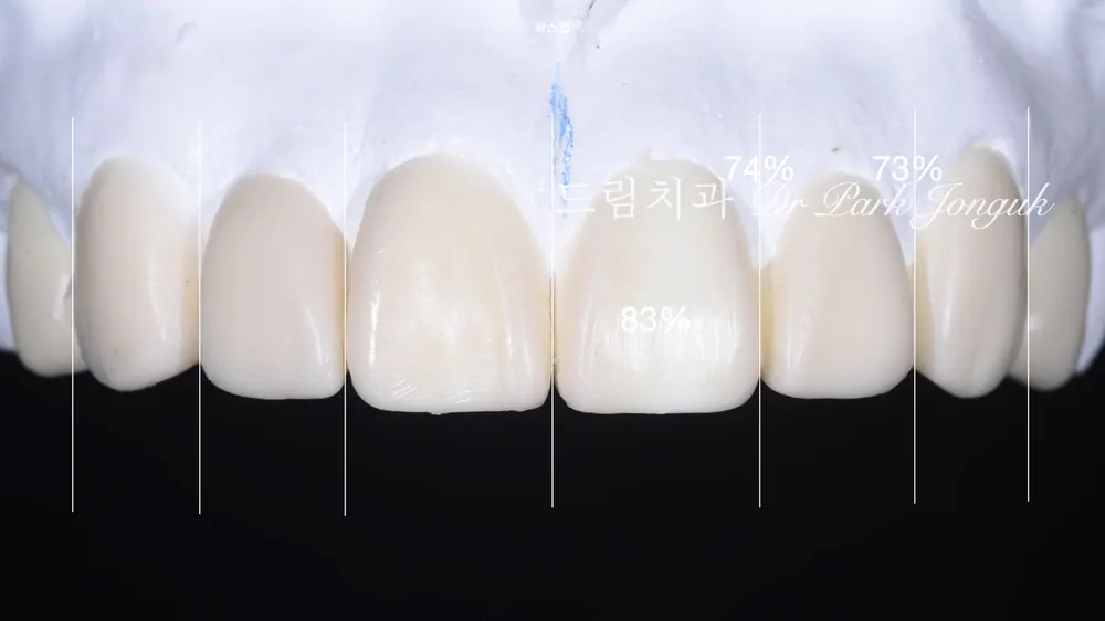 앞니 라미네이트 진단에서 치과의사의 역할! 본문 사진 5