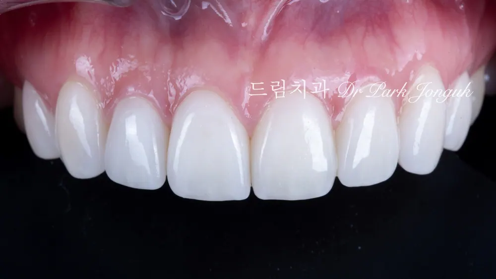 앞니 라미네이트 진단에서 치과의사의 역할! 본문 사진 6