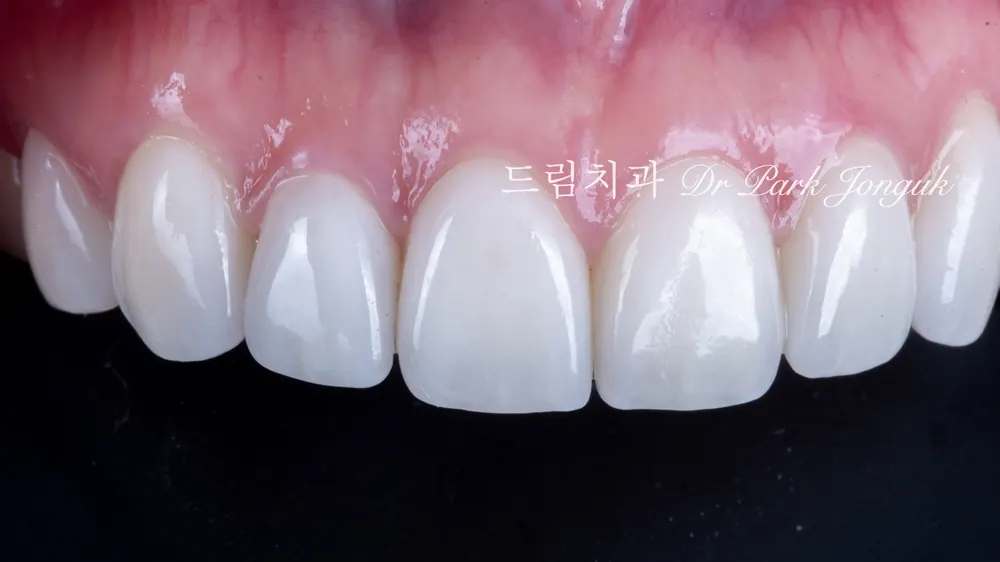 앞니 라미네이트 진단에서 치과의사의 역할! 본문 사진 7