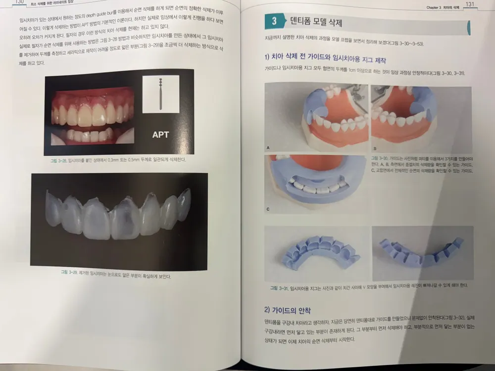 『최소 삭제를 위한 라미네이트 임상』 — 圖6