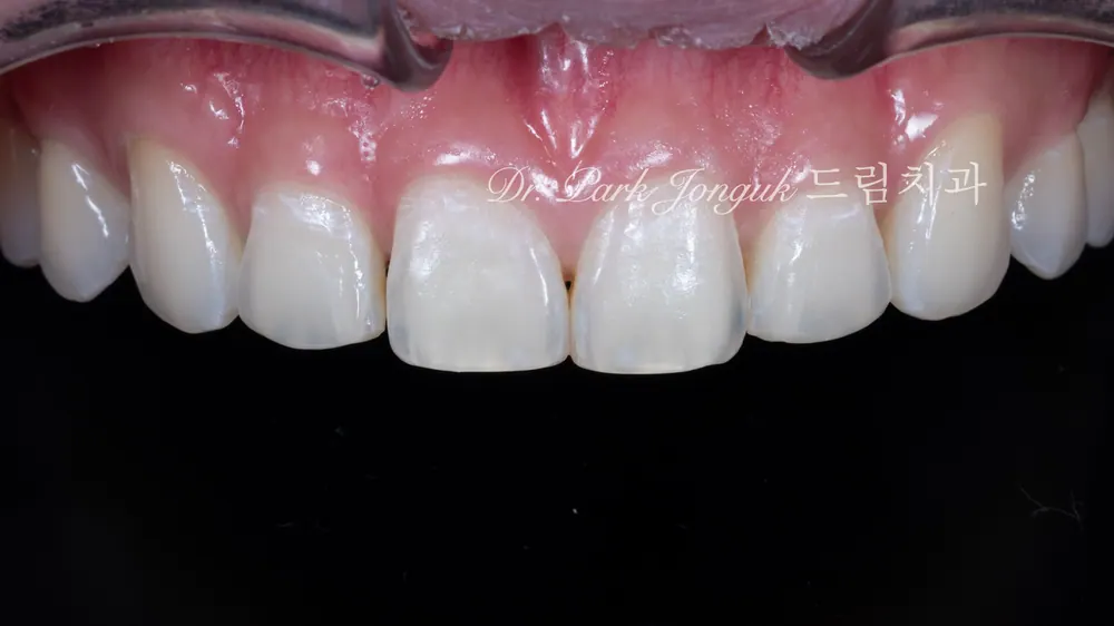 Bài giảng về Veneer sứ! — ảnh 3