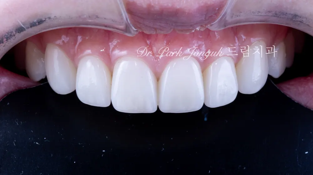 Bài giảng về Veneer sứ! — ảnh 4