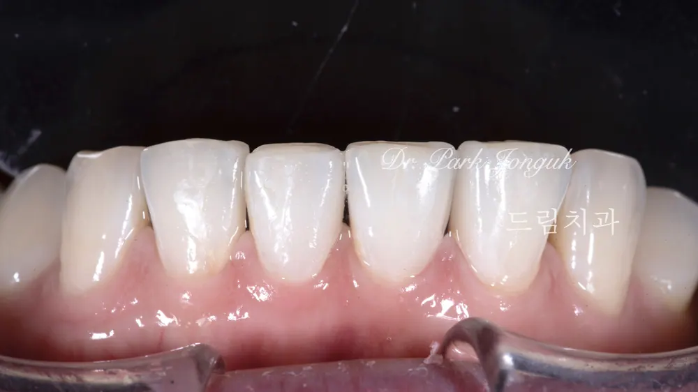 Bài giảng về Veneer sứ! — ảnh 9