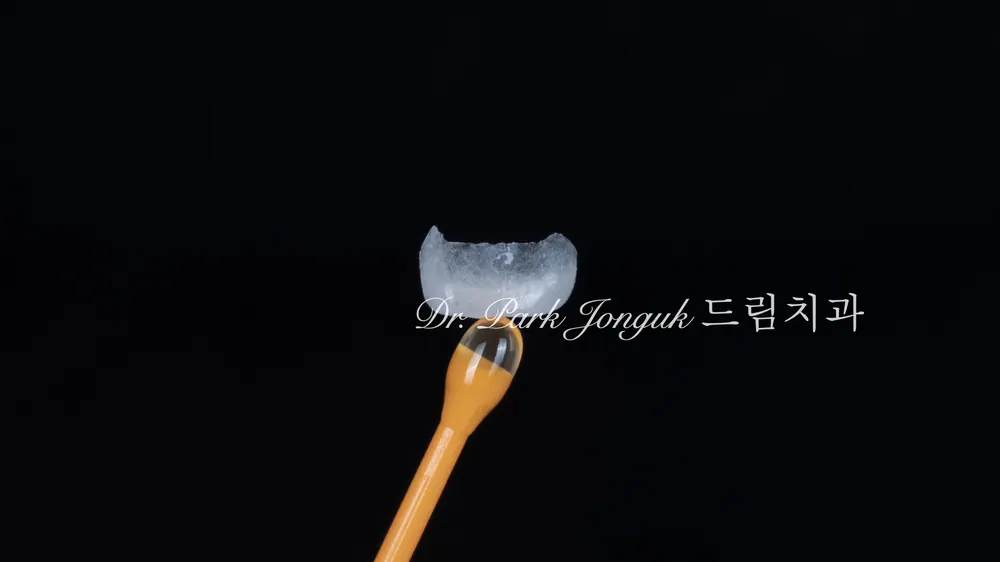 免磨牙陶瓷貼片，也能這樣做到！ — 圖2