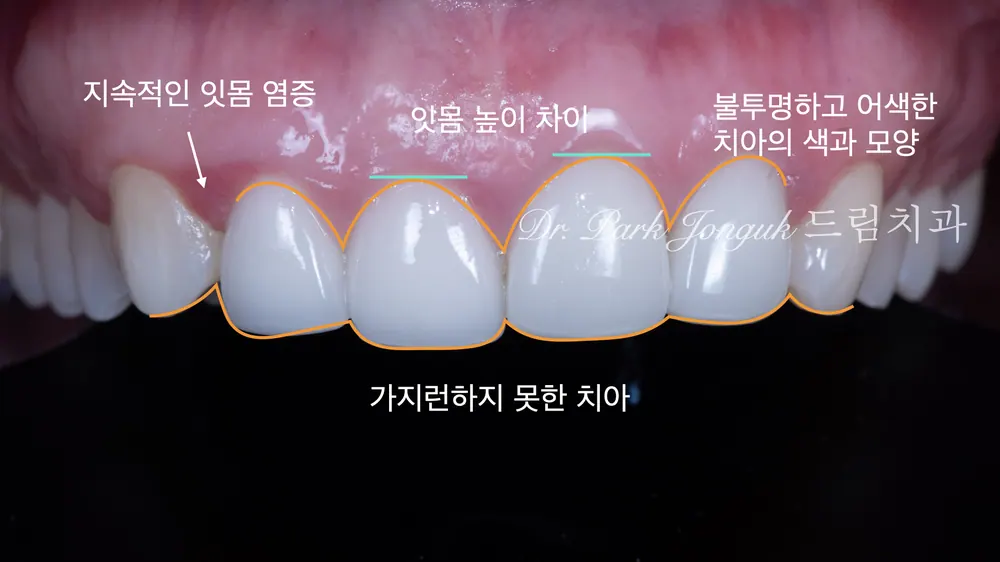 江南瓷贴面重做，兼顾牙龈与牙齿健康！ — 图2
