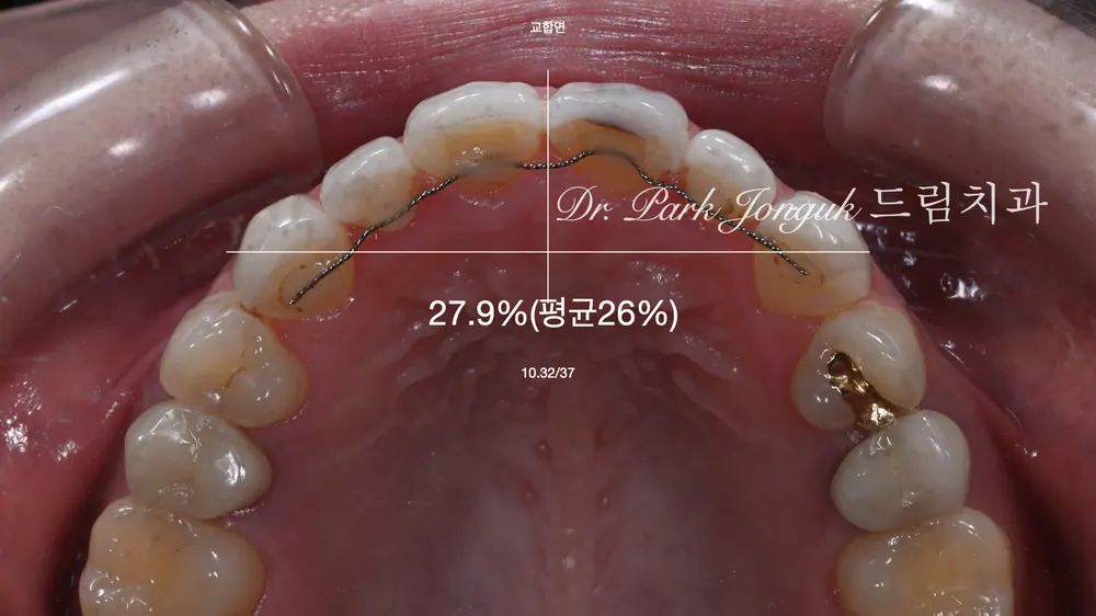 瓷贴面重做，让自然的透明感重新绽放 — 图4