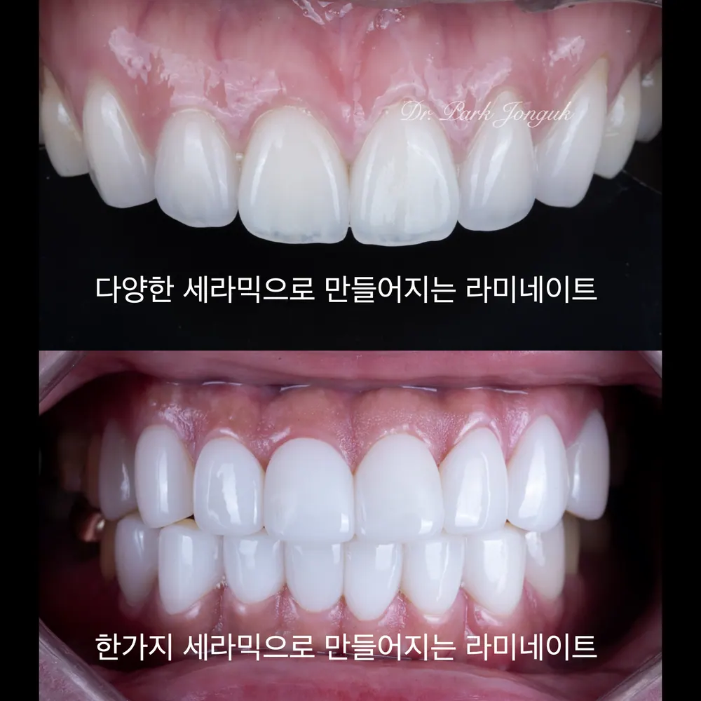 앞니 라미네이트 치료 전 꼭 알아야 할 것 본문 사진 3