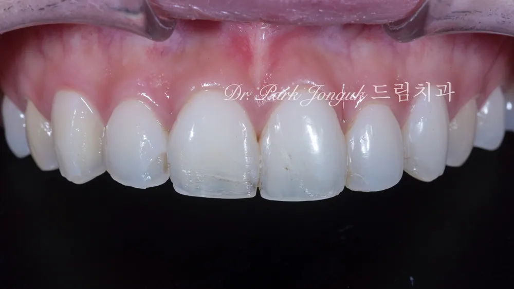 Natural Veneers: Confidence Regained Through the Handmade Method After a Same-Day Failure — photo 1