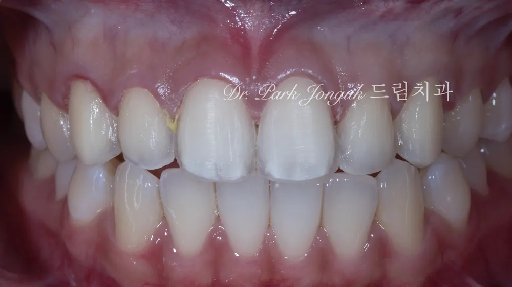 Natural Veneers: Confidence Regained Through the Handmade Method After a Same-Day Failure — photo 2