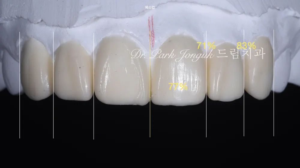 Natural Veneers: Confidence Regained Through the Handmade Method After a Same-Day Failure — photo 3