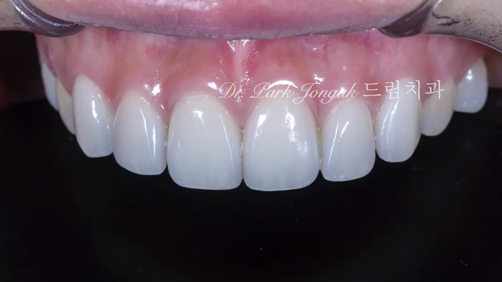Natural Veneers: Confidence Regained Through the Handmade Method After a Same-Day Failure — photo 4