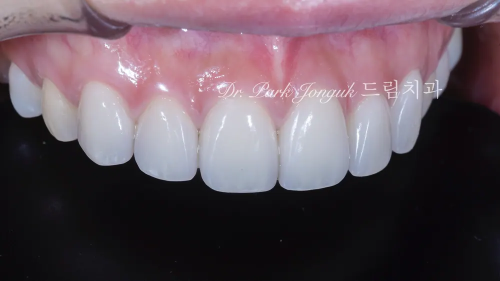Natural Veneers: Confidence Regained Through the Handmade Method After a Same-Day Failure — photo 5
